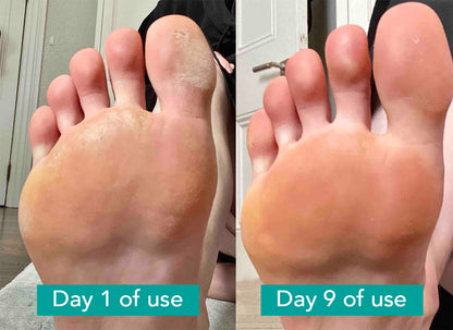 Before-After-use-Foot-cream-Mackrelle